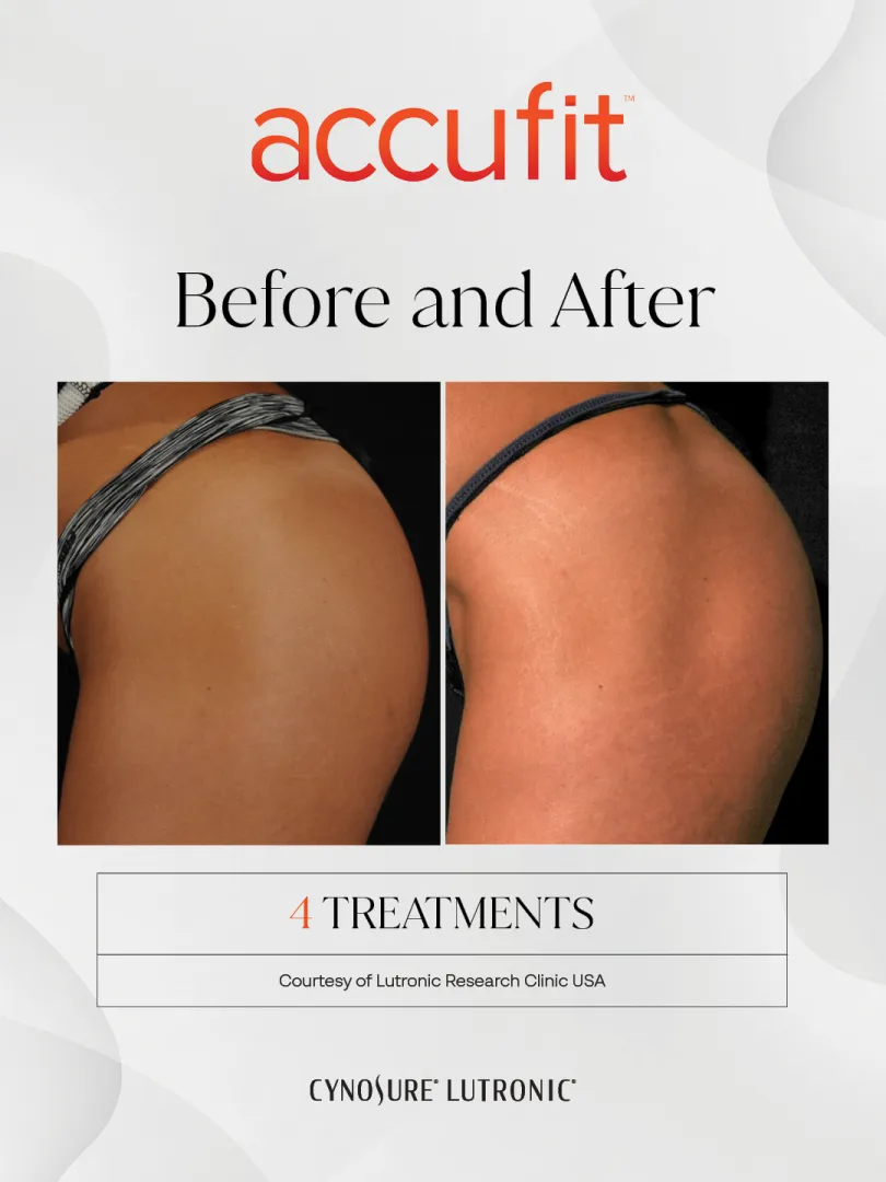 Accufit before and after: glutes, side view, after 4 treatments