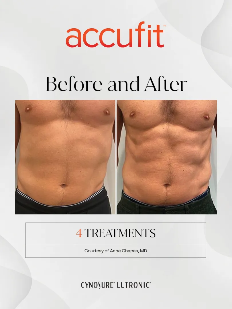 Accufit before and after: male abdomen, front view, after 4 treatments