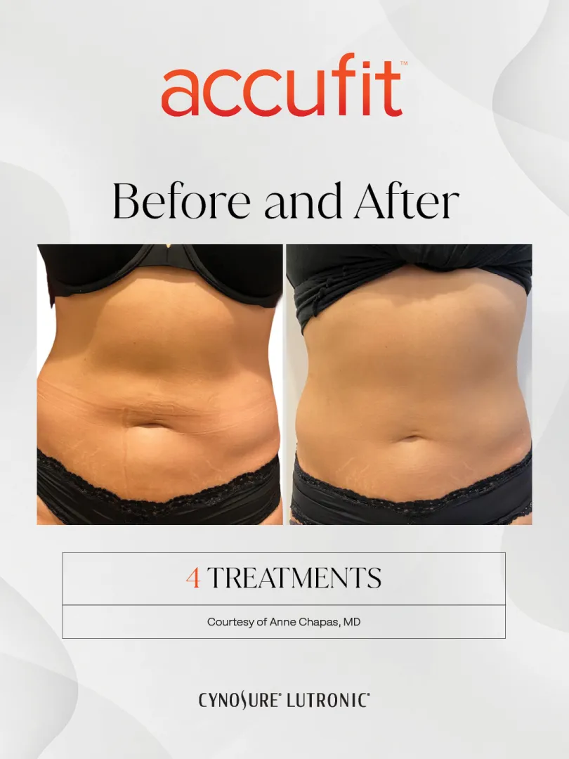 Accufit before and after: female abdomen, front view, after 4 treatments